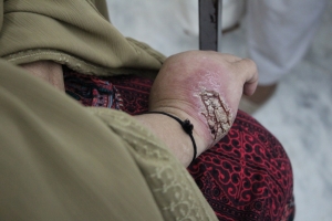 Mrs Iqbal Story - Cutaneous Leishmaniasis Treatment, Peshawar