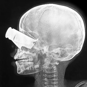 Un niño de nueve años llegó al hospital apoyado por MSF en Tine, Chad, en febrero, tras un ataque con drones en el oeste de Sudán. Presentaba una gran herida de metralla en el ojo, graves fracturas faciales y dos dedos amputados. Fue trasladado a Yamena para recibir tratamiento.