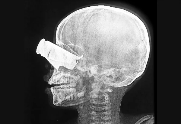 Un niño de nueve años llegó al hospital apoyado por MSF en Tine, Chad, en febrero, tras un ataque con drones en el oeste de Sudán. Presentaba una gran herida de metralla en el ojo, graves fracturas faciales y dos dedos amputados. Fue trasladado a Yamena para recibir tratamiento.