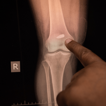 Estudio de mosrtalidad por Epicentre, de MSF