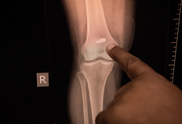 Estudio de mosrtalidad por Epicentre, de MSF