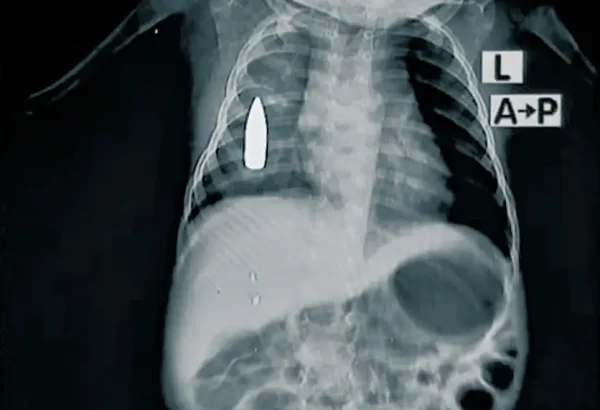 Sus cuidadores lo llevaron al Hospital con una herida de bala. Recibió un impacto de bala perdida en el pecho mientras dormía una siesta en Jartum, Sudán.