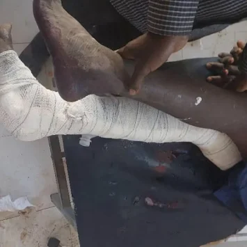 Un paciente del Hospital Universitario Nyala, que apoyamos, tras los ataques aéreos del 3 de febrero de 2025. Sudán