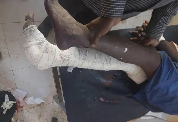 Un paciente del Hospital Universitario Nyala, que apoyamos, tras los ataques aéreos del 3 de febrero de 2025. Sudán