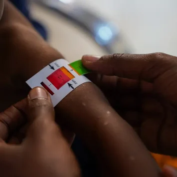 Niño con desnutrición en Baidoa, Somalia. Junio 2024. © Bishar Mayow/MSF