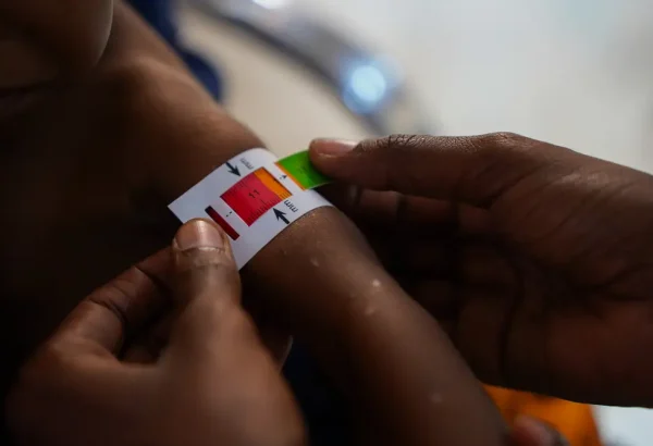 Niño con desnutrición en Baidoa, Somalia. Junio 2024. © Bishar Mayow/MSF