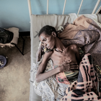 Nsanje: Treating advanced HIV