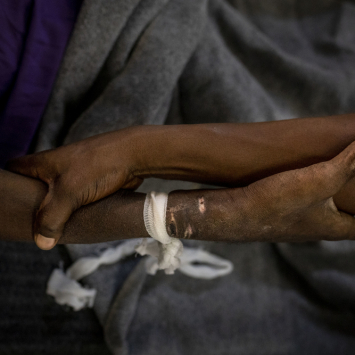 Advanced HIV in Kinshasa