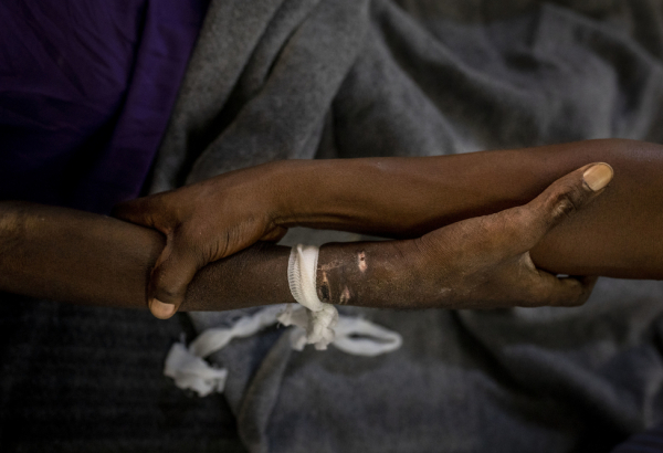 Advanced HIV in Kinshasa