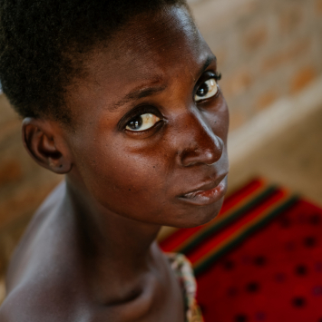 Malawi - Advanced HIV