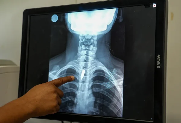 Una radiografía muestra una bala alojada en el pecho de Linda. Los cirujanos determinaron que era demasiado arriesgado extraerla, por lo que tendrá que seguir viviendo con ella. Linda fue alcanzada mientras estaba en la iglesia, cuando un grupo armado abrió fuego contra un helicóptero que se cree está vinculado a la policía. Puerto Príncipe, Haití, enero de 2026.